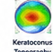 Keratoconus topography guide icon